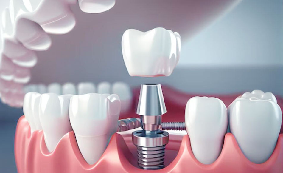 Quelles sont les composantes des implants dentaires?